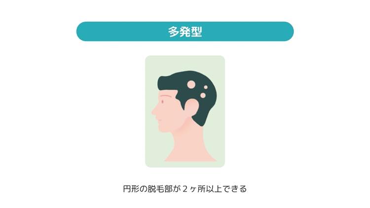 多発型