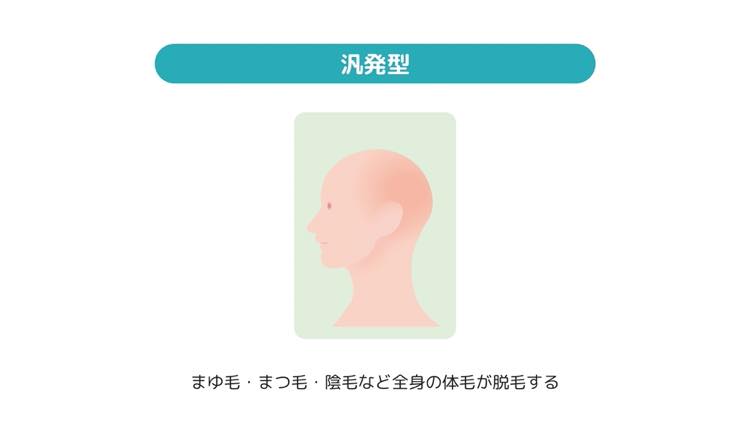 汎発型