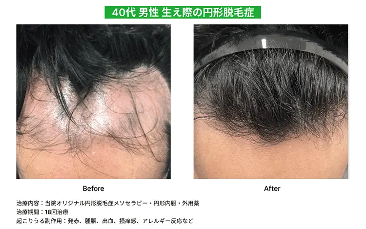 【40代男性】生え際の円形脱毛症のBefore、After画像（18回治療）