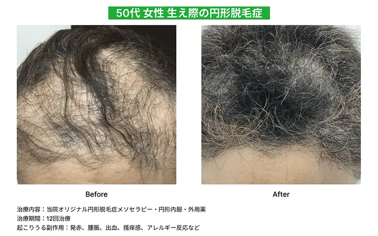 【50代女性】生え際の円形脱毛症のBefore、After画像（12回治療）