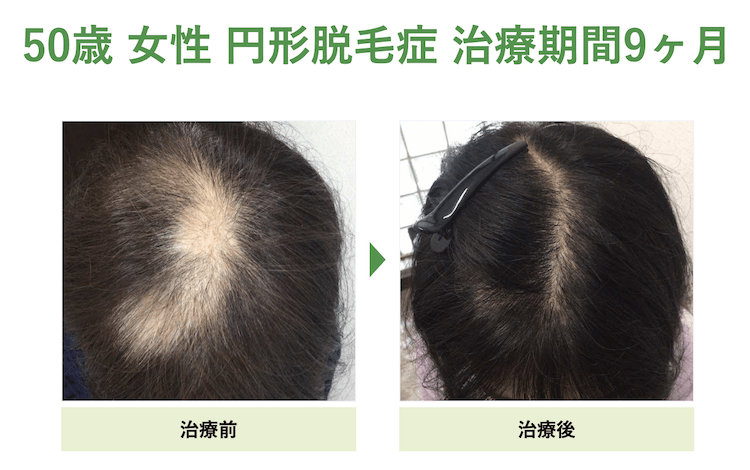 円形脱毛症の症例（50歳 女性 治療期間9ヶ月）