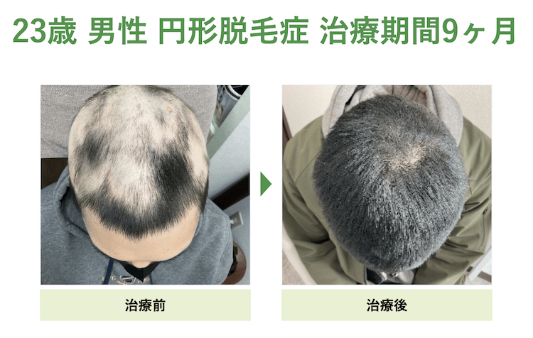 円形脱毛症の症例 23歳 男性 治療期間9ヶ月