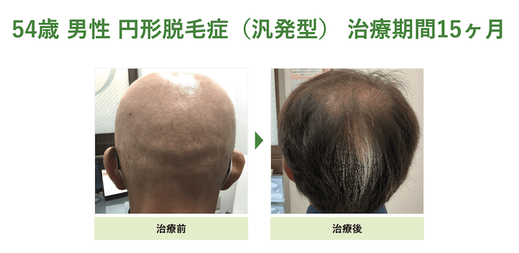 汎発型円形脱毛症の症例（34歳 男性 治療期間15ヶ月）