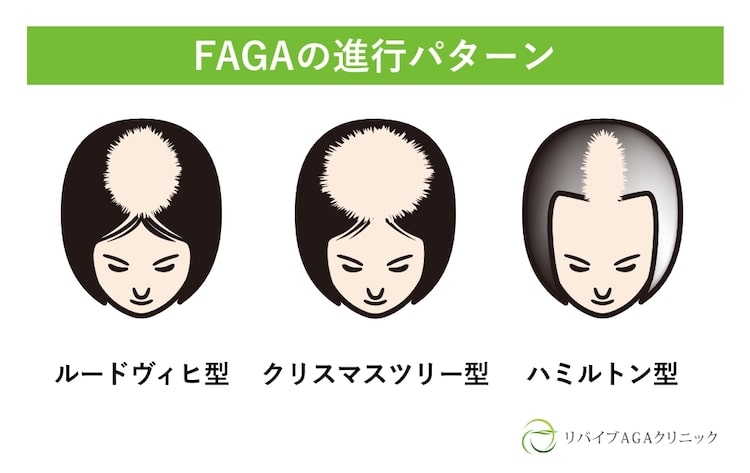 FAGAの進行パターン