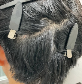 治療後