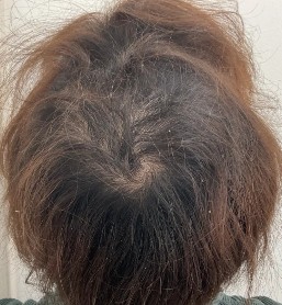治療後