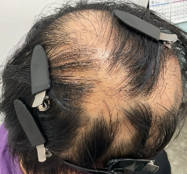 治療前