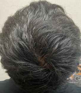 治療後
